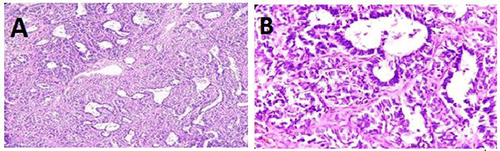 Figure 2 (A) (10x magnification) and (B), (20x magnification): Hematoxylin and Eosin (H&E) stained histologic sections from the tibial bone biopsy. These sections display tissue comprising variable-sized tubules and cords of basaloid cells characterized by monomorphic round nuclei and scant cytoplasm. This cellular arrangement is interspersed within a hypocellular spindle fibrous stroma, contributing to the histopathological diagnosis.