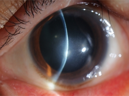 Figure 2 Slit-lamp examination shows the remaining stromal opacity of the central cornea.