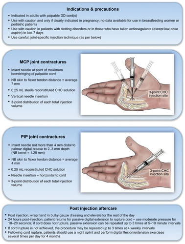 Figure 4 Diagram illustrating indications, relative contraindications, injection technique with adjustments for metacarpophalangeal (MCP) vs proximal interphalangeal (PIP) joints and suggested aftercare following successful Dupuytren disease (DD) cord rupture (as per Hurst et alCitation5).