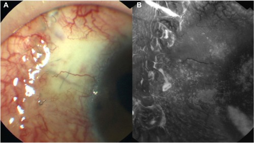 Figure 3 (A and B) Photograph taken 1 month after initiation of treatment with sodium hyaluronate eye drops.
