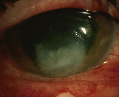 Figure 1 Typical fungal ulcer with feathery borders.