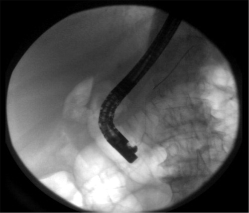 Fig. 2 ERCP: failure to cannulate and explore CBD.