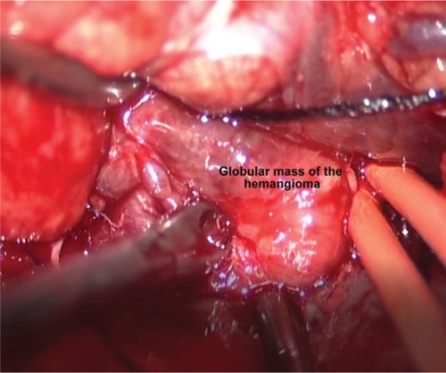 Figure 9 Intraoperative image showing the exposed globular mass of the hemangioma.