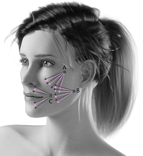 Figure 1 Face injection procedure according to the fan technique. Vector A: Entry point by zygomatic arch; Vector B: Entry point above the mandibular angle; Vector C: Entry point beside the oral commissure. The black arrows indicates the injection lines of the filler and the red arrows indicates the injection lines of the NCTF®134HA.