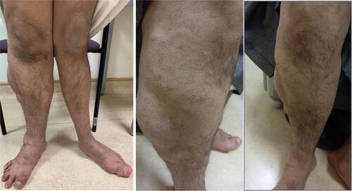 Figure 1 Composite figure depicting hemihypertrophy of the right lower limb and mega varicose veins.
