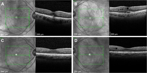 Figure 2 Spectral-domain optical coherence tomography showing improvement in asymmetric cystoid macular edema, left more than right, following bilateral implantation of sustained-release dexamethasone intravitreal implants in patient with idiopathic noninfectious posterior uveitis.