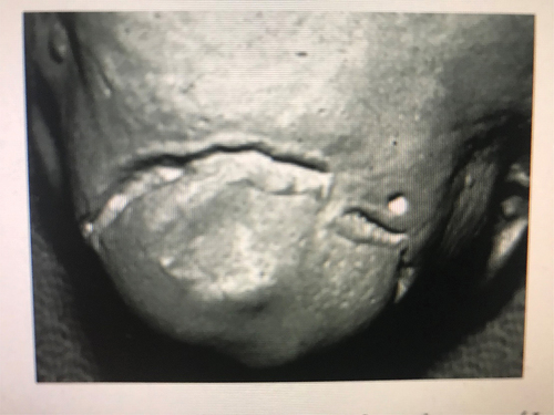 Figure 3. People vs. Marx: Bite mark wound on the bridge of the victim’s nose. Source: Gerald L. Vale, DDS, D-ABFO.