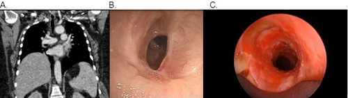 Figure 1 Grade 3, concentric, corkscrew-type stenosis seen on CT chest (A) and pre-dilation bronchoscopy (B). Post-dilation bronchoscopy reveals airway patency (C).