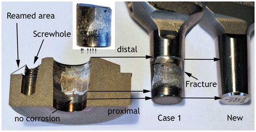 Figure 2. The cut ball head insert and stem taper (with broken-off piece placed in original position) together with a new stem taper. The screw hole was drilled into the ball head insert for removal (which was unsuccessful); reaming of the slope of the insert allowed holding on to the insert and successful removal. The distal edge of the ball head insert is imprinted circumferentially onto the stem taper (arrow). The proximal edge of the contact between male and female taper and also the edge of the corroded area are marked on the taper insert together with the corresponding position on the stem taper. The insert shows the scratches in the non-corroded area originating from entrapped bone pieces (small arrows) in the broken-off stem taper piece.