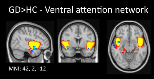 Figure 3. Increased functional connectivity in gambling disordered patients compared to healthy controls within the ventral attention network. The independent component representing part of the ventral attention network, which was used as input for dual regression, is plotted in gradient from red to yellow (3 < z < 6). Comparison of this spatial map between the two groups revealed increased connectivity strength in the right insula in gambling disordered patients. For visualization purposes, these results are shown in blue, thresholded at p < 0.05 (uncorrected). Results are superimposed on a MNI152 standard space template image; orthogonal slices through the peak voxel are shown in radiological convention (right = left).