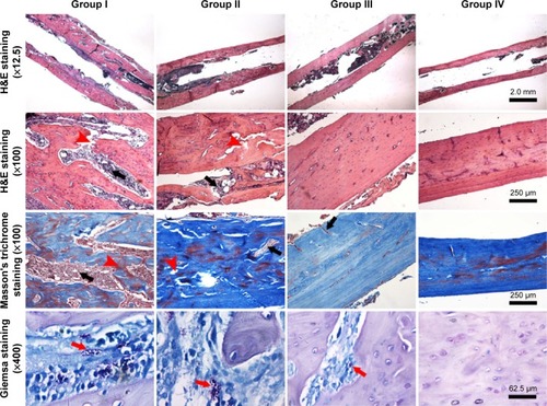 Figure 5 Representative histological images of longitudinal sections from middle femur with H&E staining, Masson’s trichrome staining, and Giemsa staining at 4 weeks after implantation.Notes: The black arrows indicate intracortical abscesses or inflammatory cells; the red arrowheads indicate bone cortex destruction; and the red arrows indicate bacteria. Groups I, II, III, and IV indicate Ti + S. aureus, NT + S. aureus, NT-G + S. aureus, and Ti + PBS, respectively. Ti, titanium without modification.Abbreviations: H&E, hematoxylin and eosin; NT, nanotubes; NT-G, gentamicin-loaded nanotubes; PBS, phosphate-buffered saline; S. aureus, Staphylococcus aureus.