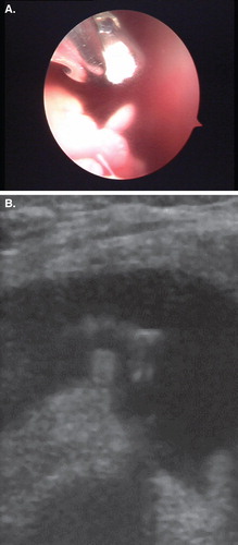 Figure 2. (A) Arthroscopic image of biopsy grab biopsying the synovial villum at the same location as Figure 1. (B) The same image captured with an US device during the same examination.