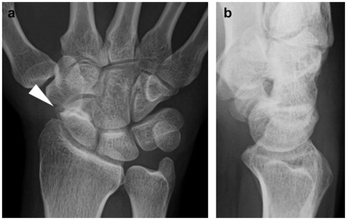 Figure 1. First radiographic assessment of the hand. (a) Posteroanterior and (b) lateral plain radiographs showing only scaphoid non-union.