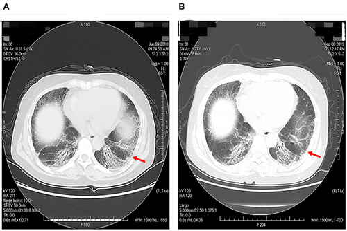 Figure 3 Represent HRCT showed the reduced lung lesion in a patient after the 9-years treatment of MP-Pulse/LTLD-GC.