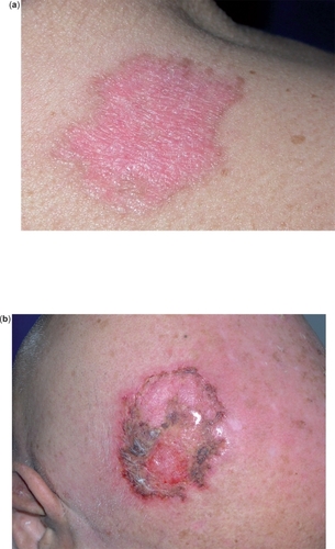 Figure 3 Local skin reactions during treatment with IQ 5% cream: marked erythema (a), erosion, exudation, and crusting (b).