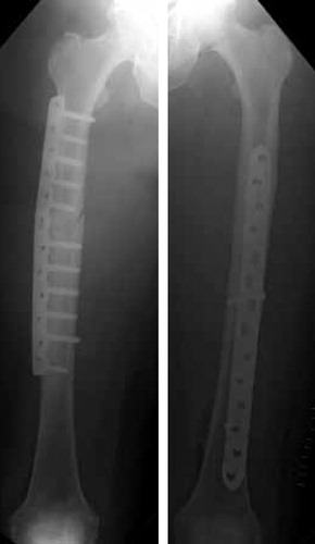 Figure 4. After plate fixation.