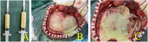 Figure 3 Images of intraoperation: (A) pus collected during surgery, (B) pus discharged after craniotomy, (C) pus after opening the dura.