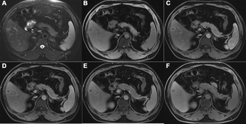 Figure 3 A 47-year-old man with colorectal cancer. (A) The T2-weighted imaging shows a well-defined hyperintense lesion in segment V. (B) In the early AP, the conspicuity score of the lesion was 4. (C–E) In the late AP (C), PVP (D), and TP (E), the lesion had clear boundaries (rating 5). (F) The lesion was depicted in sharp contrast with surrounding liver parenchyma on HBPI (rating 5).