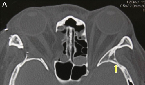 Figure 1A Axial computerized tomography scan of a 39-year-old female patient with Graves’ orbitopathy after right balanced decompression surgery with rim removal approach. The yellow arrow indicates the deep lateral area of the trigone of the greater wing of the sphenoid. This area becomes a dark corner under the intact rim approach. The area corresponding to the trigone in the right side was almost completely excised during surgery through the rim removal approach.