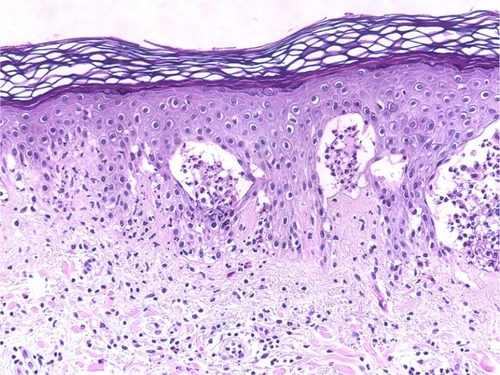 Figure 4 Dermatitis herpetiformis.