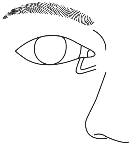 Figure 4 Figure of the laterally inclined course of the vertical lower lacrimal canaliculus.