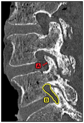 Figure 5 Example of measurements made from reconstructed parasagittal computed tomography slices bisecting the cranial and caudal pedicles at the level of interest. (A) Foraminal width, measured at the narrowest part of the foramen and (B) foraminal area.