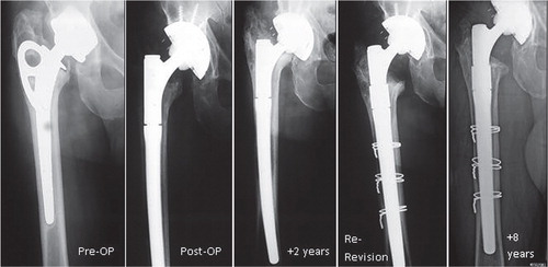 Figure 4. Subsidence with aseptic loosening of an MRP stem 2 years after revision. Revision of an aseptic loosened cementless stem and rough-surfaced Judet cup was performed with a curved MRP stem and a cementless cup in a 77-year-old man. 2 years after revision, there was a proximal 15 mm of subsidence with clinically almost fully impaired function. After exclusion of a periprosthetic infection by joint aspiration and microbiological investigation, a re-revision of the stem was performed. The cup showed a proper thigh ingrowth. A thicker MRP stem was implanted, showing good osseous integration 8 years postoperatively.