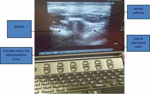 Figure 2. Ultrasound-guided pterygopalatine fossa (PPF) block