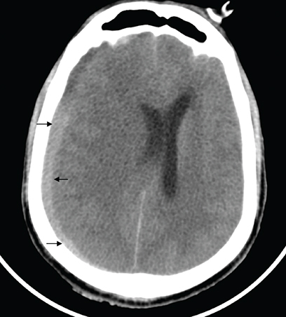Figure 3. Subdural haemorrhage in case 2.Computed tomography head of patient B showing biconcave hyperdensity in the right parieto-occipital location with associated midline shift suggestive of subdural hemorrhage.