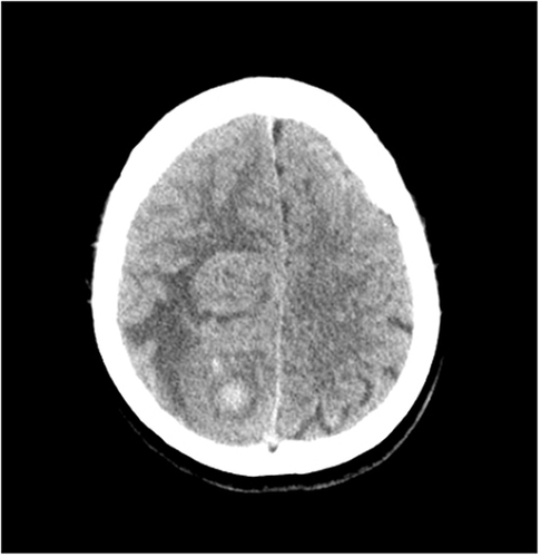Figure 1 Female (25 years old) with headache and left lower limb weakness for two months. Computed tomography plain scan showing a mixed mass with high density hemorrhage in the right frontal and parietal lobes.
