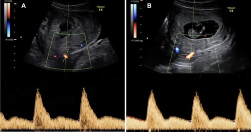 Figure 1 Uterine artery visualized by color Doppler at the level of the internal os using the sagittal approach with right (A) and left (B) waveforms.