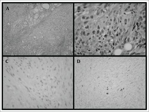 Figure 1. (A) Thyroid specimen demonstrating infiltration of tumor cells with lack of normal thyroid follicle arrangement. (B) Magnified view of the tumor cells demonstrating cells with atypical nuclei and lack of organization. (C) Tumor cells showing lack of staining with TTF-1. TTF-1 is expressed in follicular derived cells and is typically absent in poorly differentiated tumors.Citation14 (D) Cells also demonstrate lack of staining with CK7. CK7 is expressed in more differentiated thyroid tumors, including papillary carcinomas, as well as some anaplastic carcinomas. Poorly differentiated tumors show lack of staining.Citation14