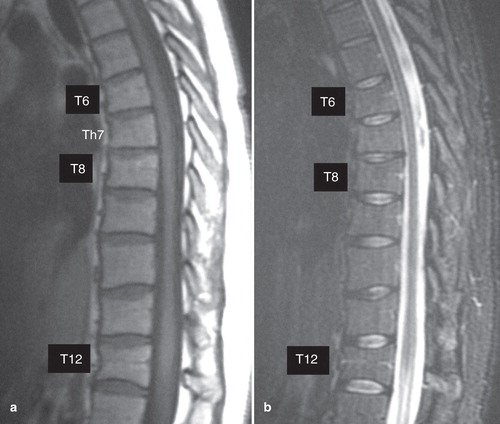 Figure 5. Magnetic resonance imaging (MRI) of the vertebrae in case 4 at 7 months after prescribing vitamin K2. MRI showed no signal intensities on T1- (A) and T2- (B) weighted images.