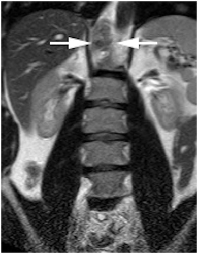 Figure 7 Use of MRI for retroperitoneal spread. Retrocrural heterogeneous T2 intermediate signal intensity LN on right side.