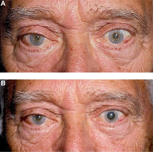 Figure 5 Cocaine Testing for Horner Syndrome.