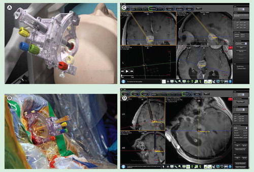 Figure 2. ClearPoint system for real-time MRI-guided biopsy. (A) Schematic of SmartFrame. (B) SmartFrame placement during surgery. (C) Pre-operative trajectory planning. Trajectory planning can be determined based on real-time information as to target the region of interest. The trajectory is indicated by the yellow line. The target is indicated by the orange circle. (D) Real-time monitoring of surgical trajectory. The needle tract (indicated by the T1-hypointense tract) can be clearly visualized in real-time throughout the surgery. Precise overlap of the intended target (orange circle) with the biopsy needle was observed.