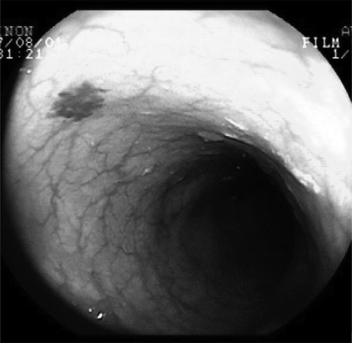 Figure 1. Endoscopic view of angiodysplasia in descending colon.
