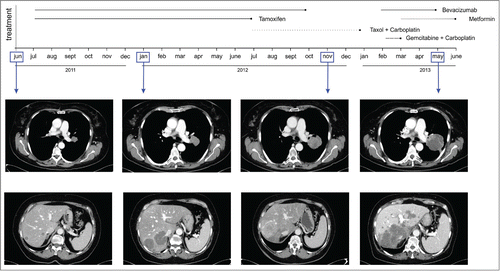 Figure 2. Timeline of morphologic changes in lung and liver metastasis by CT. Representative CT scans of lung (top panels) and liver metastasis (bottom panels) showing marked attenuation of radiologic density following combined administration of bevacizumab plus metformin in a patient with metastatic endometrial cancer.