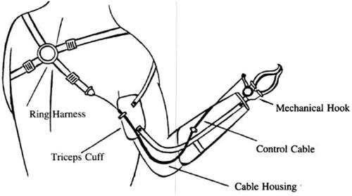 Figure 1. UE prosthesis apparatus. Based on the positioning of the ring harness, straps, and triceps cuff on the posterior torso and upper arm, scapular protraction will increase tension on the control cable. This tension on the control cable facilitates opening of the mechanical hook. A neutral scapula slackens the control cable and the mechanical hook closes. Scapular retraction will allow the mechanical hook to remain closed. Upper Limb Prosthesis Devices. Teodiano Freire Bastos-Filho, Dinesh Kumar, Sridhar Poosapadi Arjunan. Devices for Mobility and Manipulation for People with Reduced Abilities (Rehabilitation Science in Practice Series). Poosapadi Arjunan, Sridhar; Kant Kumar, Dinesh; Bueno, Leandro; Villarejo Mayor, John J.; Bastos Filho, Teodiano F, 2014, by permission of Dr. John Jairo Villarejo Mayor. This image is not covered by the terms of the Creative Commons license of this publication. For permission to reuse, please contact the rights holder.
