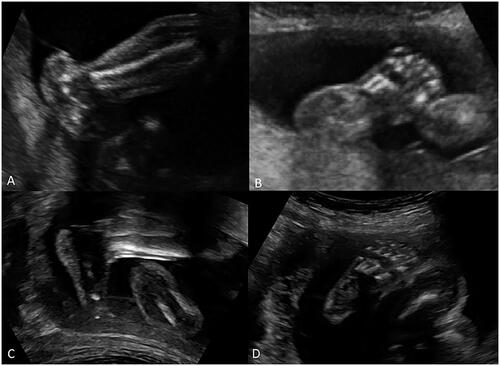 Figure 2. A morphological comparison of normal foot and foot of a fetus with CVT by prenatal ultrasound. (A, B) The prenatal ultrasound images of the foot of a fetus with CVT in the sagittal (A) and axial (B) sections. (A) A longitudinal scan of the foot sagittal section shows protuberant heel, convex plantar surface, and distal foot dorsiflexion; (B) A transverse scan of the foot axial section shows obvious valgus heel. (C, D) The prenatal ultrasound images shows the normal fetal foot of a normal fetus in the sagittal (C) and axial (D) sections.