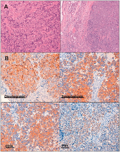 Figure 2. (A) Diffuse proliferation of small to intermediate sized cells with very scant cytoplasm and oval to round hyperchromatic nuclei. (B) Immunohistochemistry showing chromogranin, synaptophysin, CD 56 and TTF1 positivity.