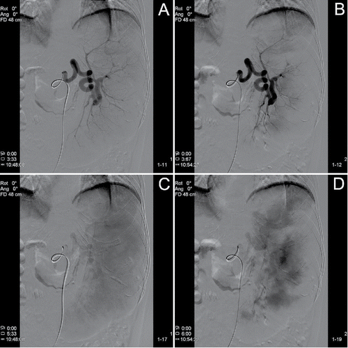 FIGURE 2. Splenic artery angiography before (A, B) and after (C, D) embolization.