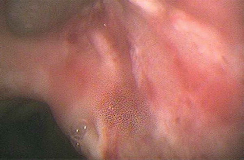 Figure1. Bronchoscopy revealing mucopurulent tracheobronchitis and a well-demarcated area of increased friability with white-colored pseudomembrane involving the carina and right upper bronchus.