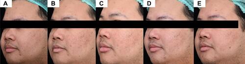 Figure 3 Postoperatively treated side with the sunscreen B. (A) Baseline, (B) 1-week 1, (C) 2-week, (D) 4-week, and (E) 6-week follow-up visit.