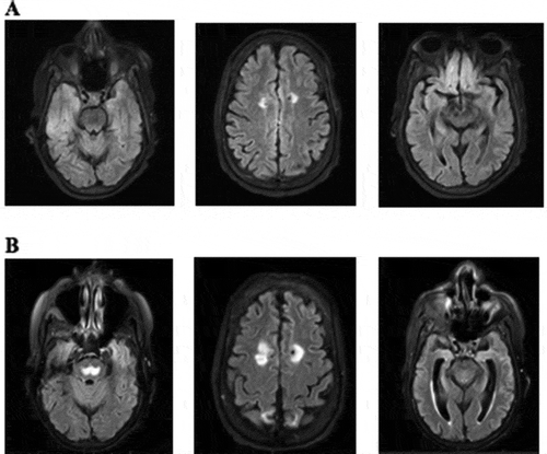 Figure 1. (a) MRI on 21 August 2020, with stable bilateral frontal, parietal and right occipital encephalomalacia. Mild atrophy and chronic small vessel ischemic disease. (b) MRI on 16 September 2020 with trident-,shaped T2 hyperintense signal within the central pons consistent with osmotic demyelination. T2 hyperintense signal is seen within the splenium of the corpus callosum, bilateral corpus striatum and within bilateral insular cortices which are most likely secondary to hyperammonemia but can also be seen in extrapontine myelinolysis
