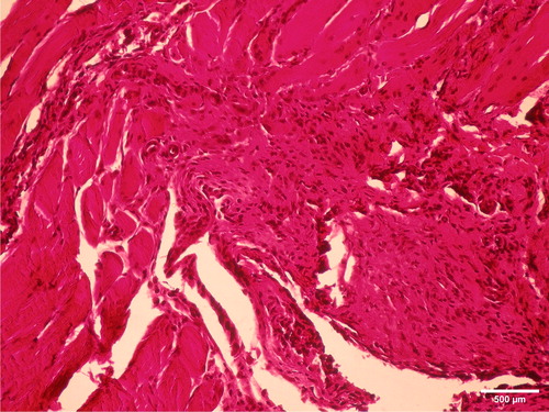Figure 8. Proliferation of connective-tissue cells and intense fibrosis with a significantly lower intensity of inflammation one week after implantation in m.biceps femoris of male Wistar ratsof hot polymerized acrylic samples. HE, ×100.