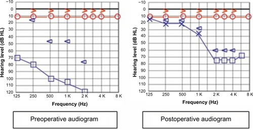 Figure 1 Preoperative pure tone audiogram showing a left-sided mixed hearing loss. Postoperative pure tone audiogram showing marked improvement, especially in the lower frequencies.