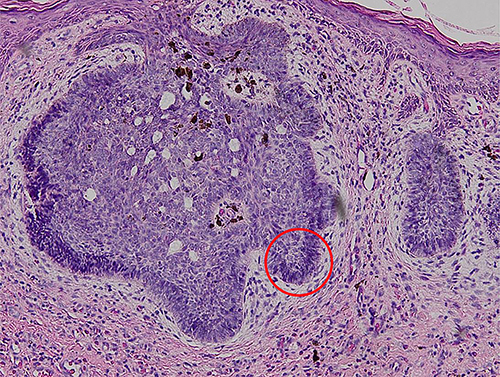 Figure 3 Histopathological examination showing that the tumor cells formed a palisading structure (red circle) (Hematoxylin-eosin stain, 100x magnification).