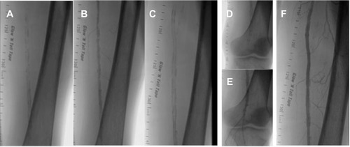 Figure 4 Severely calcified left SFA with an prior distal SFA stent (A) with severe calcification and stenosis proximal (mid SFA) and distal (popliteal above knee) to the previous stent segment (B) treated with overlapping 5.5×150 mm Supera stent proximal to the old stent (C) and a 5×100 mm Supera stent distal to the old stent (D) with no significant residual stenosis (E and F).