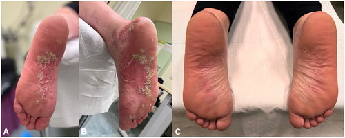 Figure 2. a-b) Paradoxical pustular psoriasis of the soles, emerging after 22 weeks of treatment with adalimumab; c) complete skin clearance after 16 weeks of treatment with ixekizumab.